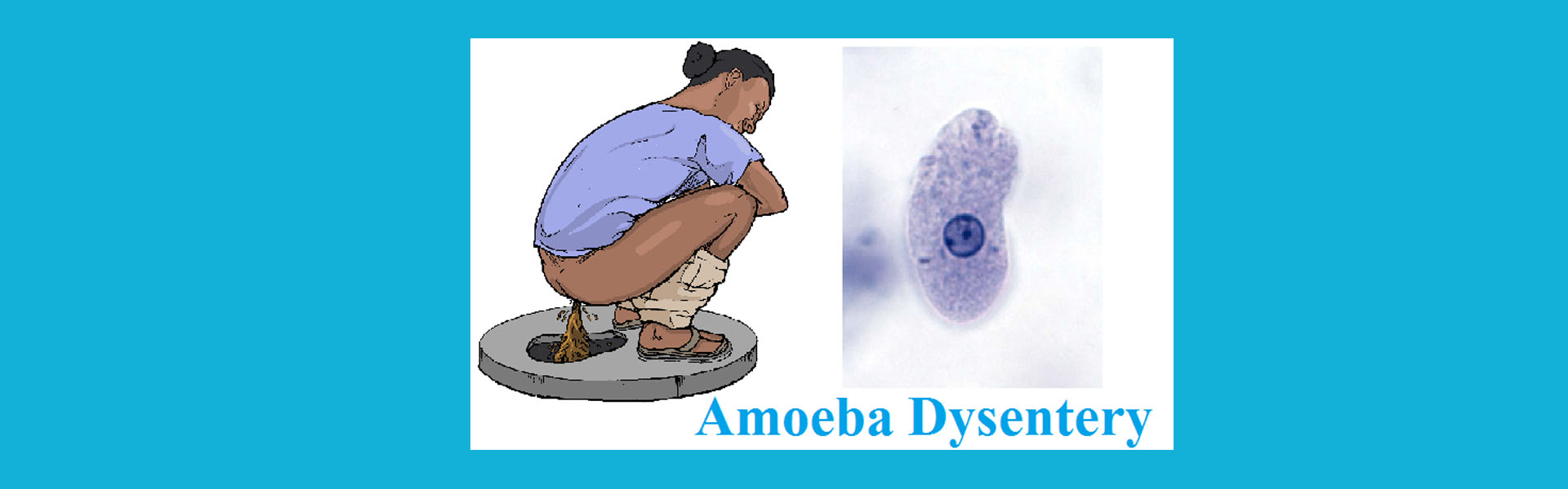 আমাশয় - এমিবিক, Dysentery - Amoebic, পাকস্থলী, Stomach, পায়খানা, মল, আম